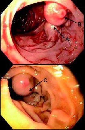 The endoscopic appearance of the bleeding duodenal varix before treatment (top panel) and after treatment (bottom panel). A. The outflow track of the duodenal varix through the right gonadal vein. B. The inflow track to the duodenal varix from the SMV and the high risk area where bleeding occurred. C. The duodenal varixpost-treatment. Note the palor and the diminution of the outfow track.