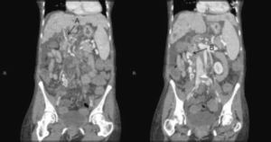 The CT appearance of the portal venous system and the duodenal varix. A. The partially occlusive portal vein thrombosis noted on coronal imaging. B. The duodenal varix penetrating the wall of the duodenum.
