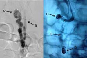 The fluoroscopic appearance of the duodenal varix before treatment (left panel) and after treatment (right panel). A. The inflow to the varix from the SMV. B. The outflow of the varix through the gonadal vain. C. The coil at the inflow track. D. The coil at the outflow track. E. Arrow pointing to the location of the duodenal varix.