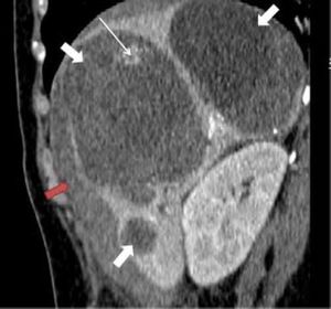 Abdominal CT showing three well defined cystic heterogeneous hepatic lesions of variable size (white thick arrow) and a subcapsular hepatic hematoma (red thick arrow). The cyst located in segment 8 shows active bleeding in the center (white thin arrow).