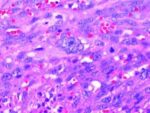 Neoplastic endothelial cells with large nuclei and prominent nucleoli. Mitotic figures are also present.