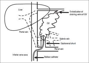 The procedure of BRTO. The balloon catheter is inserted into the gastrorenal shunt, and retrograde venography is performed under balloon occlusion of the shunt If draining veins of GV are identified, they are embolized with micro-coils or gelatin sponge particles. Then, 5% etha-nolamine oleate is infused into the space of GV until the space is completely opaque. BRTO: balloon-occluded retrograde transvenous obliteration. GV: gastric varices.