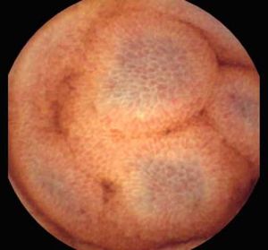Salmon roe appearance and small-bowel varices.