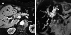 Magnetic resonance cholangiopancreatography showing (A) a perihilar, not well defined mass extrinsically comprising the distal common hepatic bile duct (arrow), and (B) a marked dilatation of the biliary tree upstream of the obstruction (arrow).