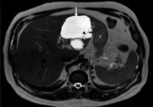 T2-weighted MRI showing a multi-loculated cystic lesion (arrow) in the left lobe of the liver with interna septations (arrowhead)