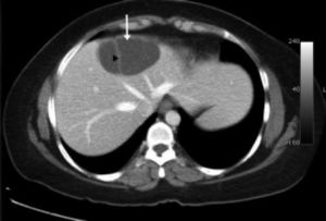 CT scan of the abdomen showing a cystic lesion (arrow) in the liver with internal septations (arrowhead).