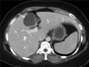 CT scan of the abdomen showing a cystic lesion in segment 4b (arrow) of the liver.