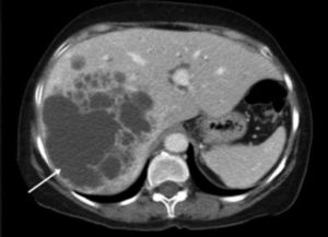 CT scan of the abdomen showing a large multi-loculated lesion (arrow) in the right lobe of the liver which was confirmed to be a BCAC following histopathological examination. BCAC: biliary cystadenocarcinoma.