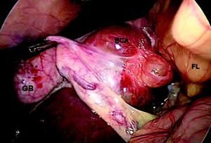 Intra-operative photograph during a laparoscopic bisegmentectomy (segment 4b and 5) for a BCA. GB: gall bladder. BCA: biliary cystadenoma. FL: falciform ligament.
