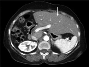 CT scan of the abdomen showing the hypertrophied left lobe (arrow) three months after resection of the lesion (right hepatectomy) in figure 4.