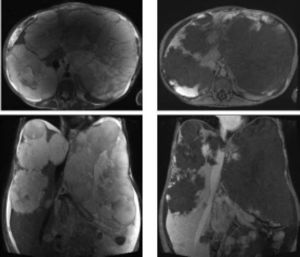 T2 weighted MRI (ieft panels) and rapid acquisition contrast imaging (right paneis) demonstrate giant hepatic hemangiomata in both hepatic iobes.