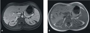 Magnetic resonance imaging revealing a tumor with 8 cm × 7.7 cm hyperintense in T1 (A) and moderately isointense in T2 (B).