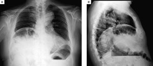 Plain (A) and lateral (B) chest radiograph suggesting the presence of subdiaphragmatic air.