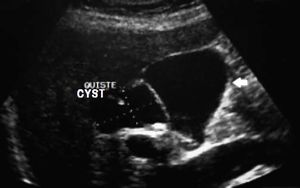 Ultrasound showing moderate dilation of the common bile duct and a large cystic mass. Arrow showing gallbladder.