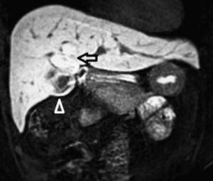 Magnetic resonance cholangiopancreatography confirmed a cystic dilatation of the right hepatic duct (arrow) next to the gallbladder (point of arrow); the head of the pancreas appeared normal.