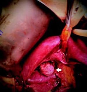 In the surgical exploration post-resection of the gallbladder, a cystic mass under the right hepatic duct was observed (arrow).