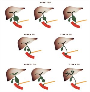 Todanis classification of choledochal cysts.