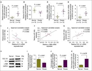 High miR-146b expression is correlated with down-regulation of KLF4 in vivo. A. Expression of miR-146b was up-regulated in fibrotic liver tissue compare with that in normal liver tissue. B. KLF4 mRNA expression was down-regulated in fibrotic liver tissue compared with that of normal liver tissue. C. The mRNA expression level of α-SMA was up-regulated in fibrotic liver tissue compared with that of normal liver tissue. D. COL1A1 mRNA expression was up-regulated in fibrotic liver tissue compared with that of normal liver tissue. E. Expression of miR-146b negatively correlated with KLF4 mRNA expression. F. Expression of miR- 146b positively correlated with α-SMA mRNA expression. G. Expression of miR-146b positively correlated with COL1A1 mRNA expression. H. KLF4, COL1A1 and α-SMA protein levels were evaluated by Western blot assays. I. KLF4 protein content was down-regulated in fibrotic liver tissue compared with that of normal liver tissue; GAPDH was used as an internal control. J. Protein content of α-SMA was up-regulated in fibrotic liver tissue compared with that of normal liver tissue; GAPDH was used as an internal control. K. COL1A1 protein content was up-regulated in fibrotic liver tissue compared with that of normal liver tissue; GAPDH was used as an internal control. Data are presented as the mean ± SEM from ten replicates in each group.