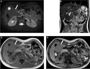 A 25-year-old female with focal nodular hyperplasia (FNH). Axial (A) T2-weighted MR image (with fat suppression) and coronal (B) T2-weighted MR image (without fat suppression) show an exophytic isointense right sub-hepatic mass (arrow) compressing the galbladder. Axial in-phase (C) and opposed-phase (D) T1-weighted GRE images show no fat component in the lesion.