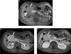 A 25-year-old female with focal nodular hyperplasia (FNH). Axial T1-weighted images prior to gadolinium injection (A) and after injection, at the arterial phase (B) and venous phase (C) show an exophytic right sub-hepatic hypervasular lesion (arrow). The mass shows homogeneous enhancement during the arterial phase and is slightly hyperintense on the portal venous phase image. Central scar is clearly visible and enhances at the venous phase. These features are compatible with diagnosis of FNH.
