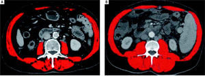 Segmental CT images comparing two cirrhotic patients with hepatocarcinoma with the same Body Mass Index. A. A sarcopenic patient. B. A non sarcopenic patient.