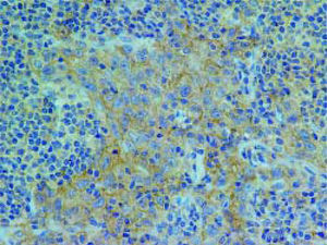 Programmed death ligand-1 membranous positivity in the neo-plastic cells and tumor-infiltrating lymphocytes of the periportal lesion (PD-L1, 400x).