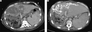 The follow-up liver triphase CT studies after re-exploration. A. CT study of 3rd week: A large portion of hypo-enhancement with heterogeneity of the liver parenchyma in the graft was noted. Congestion with hypo-perfusion was likely. B. CT study of 8th week: The liver graft enlarged in size, compatible with liver regeneration. Geographic calcification was noted in the previous congestion areas of the liver graft, probably resulting from congestion necrosis. Some resolution of necrosis was present.