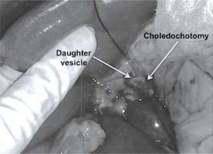 Open bile duct and the appearance of daughter vesicles.