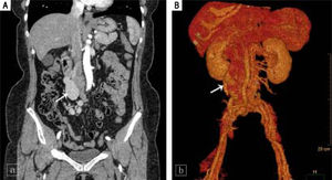 Coronal computed tomography (A) and volume-rendering 3-dimensional (B) images show the aberrant vessel traveling in a tortuous, downward-right path. Uneven thickening and an-eurysmal dilation with a diameter of 33 mm are seen (white arrow).