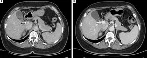 Axial contrast-enhanced CT images show the change in size of portal vein before (A) and after (B) shunt closure (white arrow).