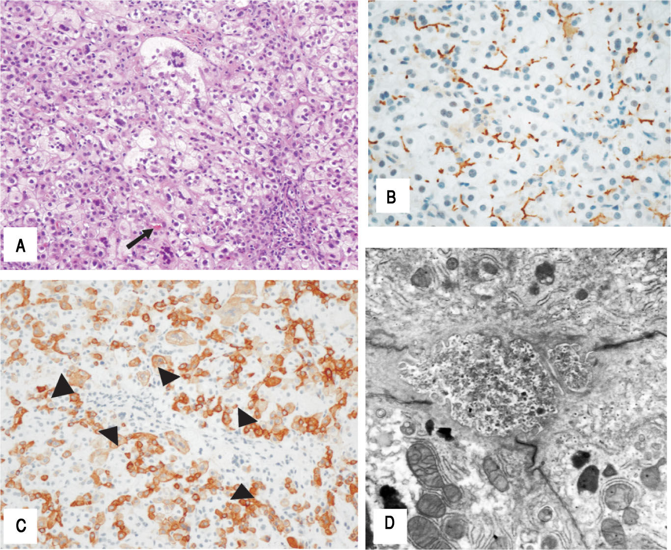 Bsep Form A Rare BSEP Mutation Associated with a Mild Form of Progressive ...