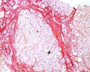 Liver specimen showing fibrotic lesions surrounding liver regenerating nodule. Syrius red staining. Magnification 40x.