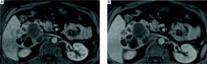 Case 1. MRI abdomen. Axial fat-suppressed gadolinium-enhanced T1-weighted MR images obtained in the arterial (A) and portal (B) venous phases demonstrates that the multiloculated mass does not arterial phase enhance, and its soft tissue components are isointense to the liver during the portal venous phase.