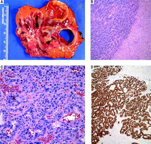 Case 1. Pathology. A. The cut surface of the tumor displayed well-defined, irregular borders. The variegated lesion was red to yellow, solid and cystic. B. Tumor cells are seen on the left arranged in trabeculae and nests. Residual benign hepatic parenchyma is seen on the right (H&E, 10x). C. On higher power, the tumor cells display round nuclei and moderate amounts of eosinophilic cytoplasm. Nuclei show a characteristic stippled (“salt and pepper”) chromatin pattern with inconspicuous nucleoli (H&E, 40 x). D. Synaptophysin and chromogranin (not shown) immunostains showed strong and diffuse cytoplasmic positivity. Acinar architecture can also be appreciated (synaptophysin, 10 x).