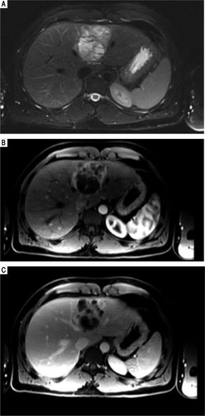Case 2. MRI abdomen. A. Axial fat suppressed T2-weighted MR image demonstrates a complex multiloculated cystic mass originating in the medial segment of the left lobe of the liver. Note the fluid-fluid level within a locule. B. Axial fat-suppressed gadolinium-enhanced T1-weighted MR images in the arterial and (C) portal venous phases demonstrates the soft tissue components of the complex cystic mass show arterial phase enhancement (B) and remains slightly hyperintense with respect to hepatic parenchyma on the portal venous phase. This finding can be seen with neuroendocrine tumors, but is not specific.