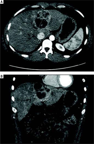 Case 2. CT abdomen. Computed tomography scan with intravenous contrast shown in axial (A) and coronal (B) planes.