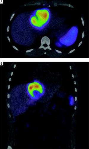 Case 2. Octreotide scan. IN-111 octreotide scan shown in axial (A) and coronal (B) planes demonstrates intense activity within the liver mass consistent with a neuroendocrine tumor.