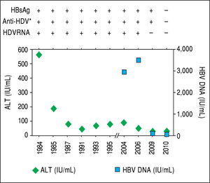 After acute hepatitis due to HDV superinfection, ALT levels de creased although intermittent elevations were documented during follow-up. In 2004, when the patient started monitoring, HBV DNA was quantified and levels remained below 20,000 UI/mL. In 2010, without any specific treatment, HDV RNA became undetectable, and spontaneous HBsAg sero-clearance was documented. * IgG anti-HDV.