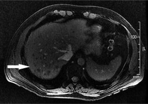 T1-weighted MR image reveals multiple hypointense lesions of the liver and of variable size.