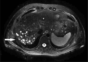 T2-weighted MR image these lesions appear hyperintense (white arrows).