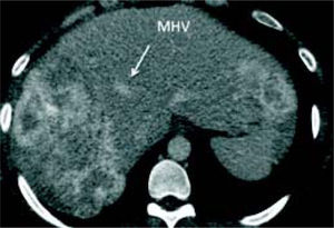 Post-chemoterapy CT scan. CT scan after 13 cycles of chemoter-apy: segments 1 and 4 are free of disease. MHV (arrow) is close to margin.