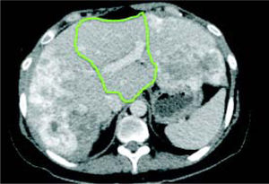 Initial future liver remnant. FLR (segments 1 and 4) estimated at 389 g, corresponding to 22% of SLV.