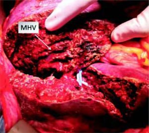 Stage 1 surgery. Intraoperative view of liver transection. MHV (arrow) is preserved.