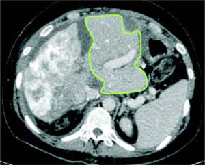 Future liver remnant after stage 1 surgery. CT scan on 8th POD: FLR increased to 633g (36% of SLV).