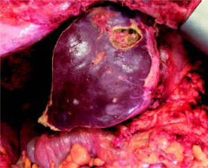Stage 2 surgery. Final aspect of liver remnant after stage 2 surgery.