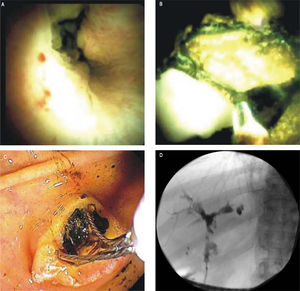 Representative SpyGlass™ image showing PSC-associated common bile duct stricture (A).Representative SpyGlass™ image in the common bile duct (B) and endoscopic image at the level of the ampulla (C) demonstrating choledocholithiasis. Corresponding cholangiogram performed during ERCP showing PSC-related changes in the biliary tree with strictures and beading involving predominantly the left biliary system (D).