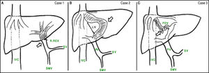 Schematic anatomy of the shunts (white arrows) in: A. Case 1-Congenital mesenterico-portal Rex shunt. B. Case 2- Type II portosystemic shunt (congenital intrahepatic portocaval shunt). C. Case 3- Type II portosystemic shunt (PDV). IVC: Inferior vena cava. R: Recessus. SV: Splenic vein. SMV: Superior mesenteric vein. LV: Ligamentum venosum. PV: Portal vein.