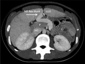 CT angiography of case 1 shows a congenital mesenterico-portal (MP) Rex shunt (arrow). LLLS: Liver