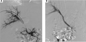 Complete occlusion of extrahepatic portal vein is identified in a portogram (A). Via transhepatic approach a covered stent is placed restoring the antegrade flow through the portal vein (B).