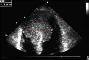 Echocardiographic imaging (subcostal 4 chamber view). The dotted line shows a large and iso-echogenic ventricular septal size (5.58 cm), extending to the cardiac apex and septum.